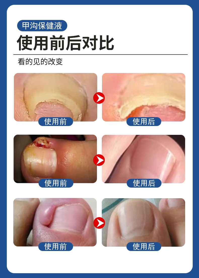 甲溝炎專用液有用嗎？使用前后對比